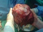 تومور ۱۰کیلویی از بدن یک زن در کرج خارج شد